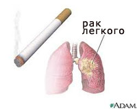 рак лёгких